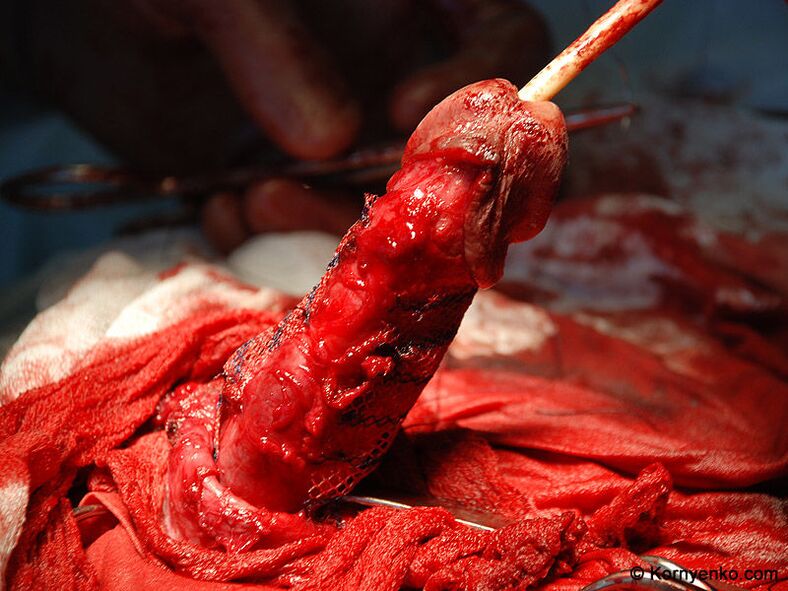 inštalácia kolagénovej matrice na zväčšenie penisu