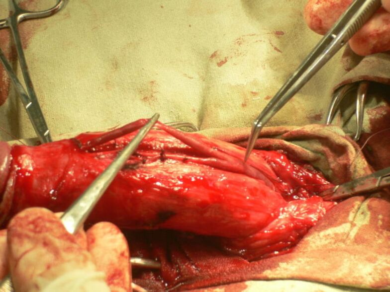 lipofilling penisu na zväčšenie