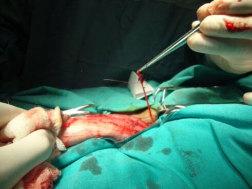 operácia na zväčšenie penisu