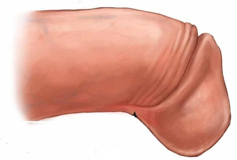 ako zväčšiť žaluď penisu